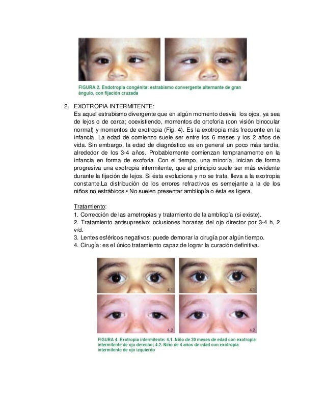 Operacion estrabismo antes y despues de adelgazar